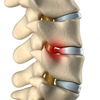 spine_discherniation_200_200_80
